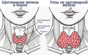 Появления коллоидных узлов на щитовидной железе Коллоидные узлы