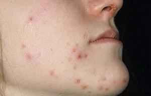 Что такое стрептодермия Описание заболевания стрептодермии