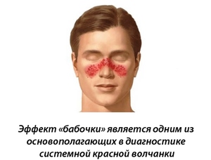 Красная волчанка - внешние проявления на лице Красная волчанка на лице человека