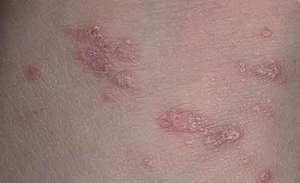 Плоский красный лишай Плоский красный лишай
