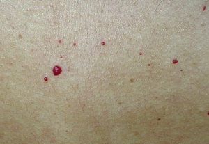 Аллергический дерматит как причина появления красных точек на теле у ребенка С чем связано возникновение красных точек на теле