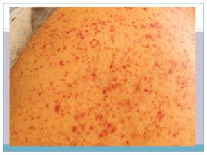 Сыпь в виде красных точек у взрослого и ребенка может появиться из-за инфекционного заболевания Чем вызвано возникновение красных точек на теле