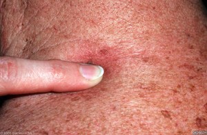 Красные точки на теле, как родинки, – это печеночная пурпура Отчего появляются красных точек на теле