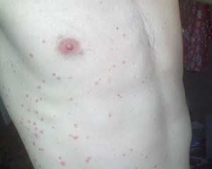 Нарушения функций поджелудочной железы (синдром Тужилина) Синдром Тужилина