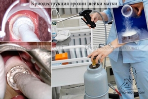 Криодеструкция эрозии шейки матки Эрозия матки лечение
