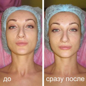 Криомассаж лица, шеи Азот для лица