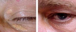 Профилактика ксантом эруптивный ксантоматоз