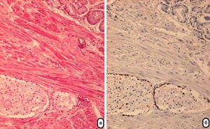 Ксантоматоз в пожилом возрасте Диагностика ксантоматоза