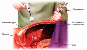 Лечение внематочной беременности Хирургическое лечение внематочной беременности