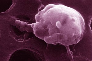 Стадии процесса развития опухоли Развитие опухоли