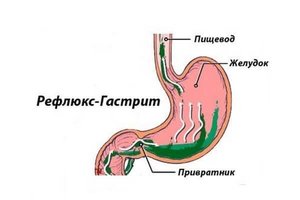 Диагностика рефлюкса Дуодено гастральный рефлюкс симптомы
