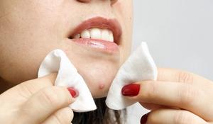 Как выдавливать фурункул самостоятельно Правила выдавливания прыщей