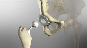 Лечение головки тазобедренного сустава Лечение головки тазобедренного сустава хирургическим путем