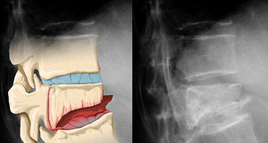 Хирургическое лечение компрессионного перелома позвоночника Лечение компрессионного перелома позвоночника