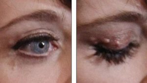 Диагностика ксантоматоза Лечение народными средствами ксантелазмы век