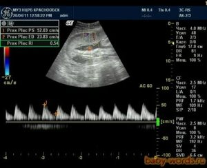 Доплерография нарушения маточного плацентарного кровотока Симптомы нарушения маточного плацентарного кровотока