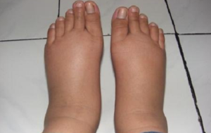 Народные методы лечения отёка стопы Отёк ноги выше щиколотки