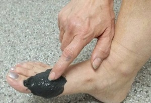 Как лечить подагру в период обострения Способы лечения при подагре в период обострения