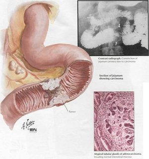 Симптомы рака Какие симптомы у рака