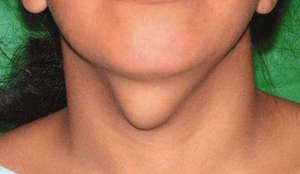 Диффузное увеличение щитовидки Узловая гиперплазия щитовидной железы