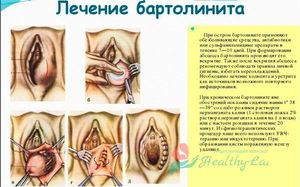 Народные методы лечения Что делатье если бартолиновая железа воспалилась