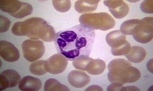 Причины повышения лейкоцитов Почему повышены лейкоциты в мазке