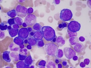 Результаты обследования Как понизить лейкоциты в мазке