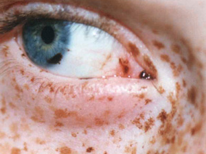 Синдром L.E.O.P.A.R.D Как проявляется синдром L.E.O.P.A.R.D