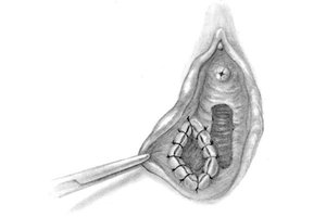 Диагностика заболевания Как ллечат воспаление бортолиновой железы