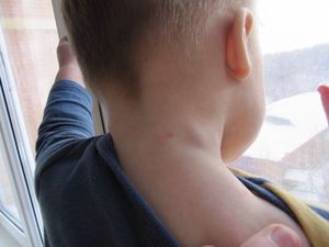 Что такое лимфаденит Описание патологии лимфаденит