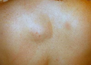 Разновидности липомотоза Какие есть виды заболевания