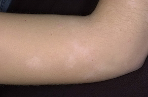 Белый лишай ещё имеет название простой Белый лишай у ребенка