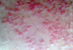 Плоский красный лишай на коже Плоский красный лишай