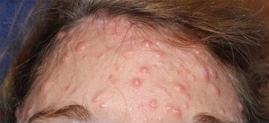 Лицо в папулах Лицо в папулах на лбу