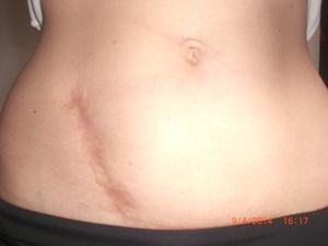 Левомеколь при обработке послеоперационных швов и при родовых разрывах промежности у женщин Левомеколь при родовых разрывах промежности у женщин