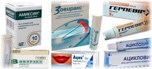 Как лечить герпес на голове Лечение герпеса