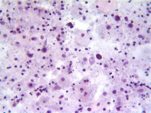 Мазок цитологии Стекло с мазком отправляется в лабораторию для исследованмя