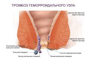 Лечение наружного геморроя у женщин Наружный геморрой