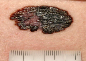 Симптомы меланоза Дюбрея Причины появления меланоза