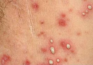 Пустулы на коже Множественные пустулы на коже