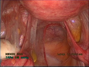 Множественные спайки при эндометриозе Множественные спайки после хирургического вмешательства