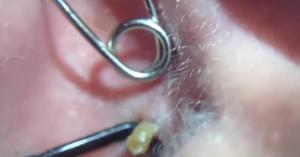 Выдавливание прыща в ухе Правила выдавливания прыщей