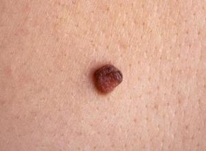 Можно ли трогать родинку Когда родинку трогать нельзя