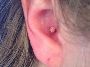 Симптомы развития прыща в ухе Удаление прыщей в ушах