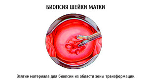 Что такое биопсия шейки матки Как делают биопсию шейки матки при эрозии
