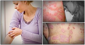 Стационарная стадия заболевания Как лечить псориаз