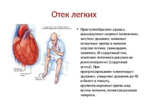 Симптоматика отека легких Какие симптомы отека легких
