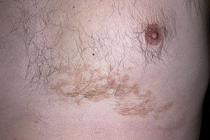 Причины появления невуса Беккера Развитие невуса Беккера