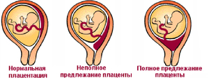 Диагноз низкая плацентация Низкое расположение плаценты