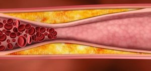 Медикаментозная терапия при атеросклерозе шеи атеросклероз шейных сосудов